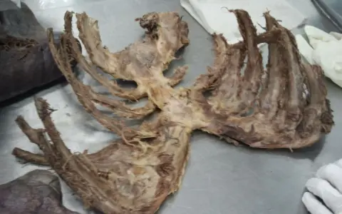 Ein menschliches Brustkorb-Präparat zeigt, wie viele Rippen ein Mensch hat. Die Rippen sind auf einem metallischen Tisch ausgebreitet.